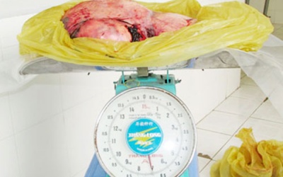 Khối u 7 kg trong bụng cụ bà 78 tuổi