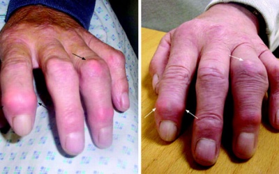 Nhật Bản phát triển thuốc chữa bệnh đa xơ cứng