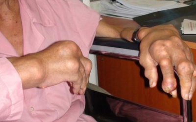 Lắng đọng tinh thể urat ở bệnh nhân gout