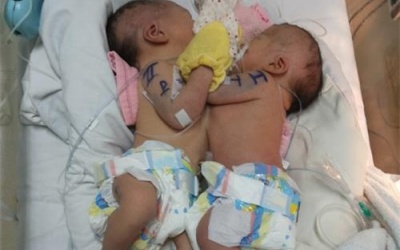 Thêm hai bé sơ sinh dính nhau