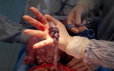 Thai nhi có dây rốn thắt nút 2 vòng vẫn sống sót