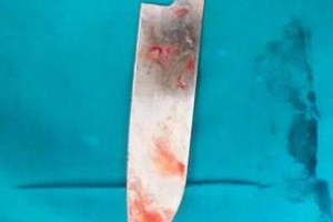 Cứu sống nữ bệnh nhân bị dao đâm sâu vào cơ thể 12 cm