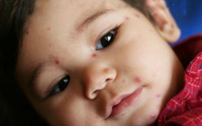 Tránh những lỗi thường gặp khi chăm sóc trẻ bị thủy đậu