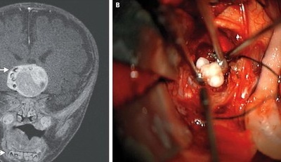Chuyện hy hữu: Bé trai có răng mọc trong khối u não