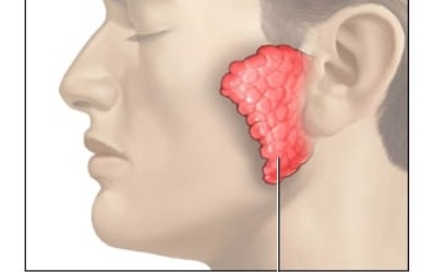 Bài thuốc chữa quai bị