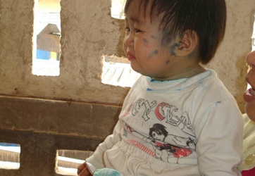 Phòng bệnh cho trẻ khi thủy đậu vào mùa