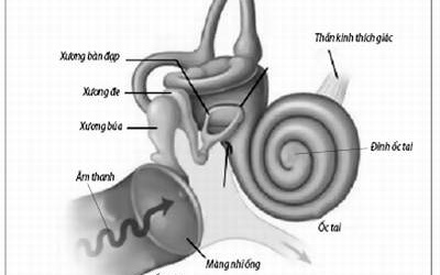 Viêm tai giữa ứ dịch