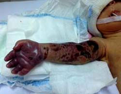 Cứu cánh tay trẻ sơ sinh bị hoại tử