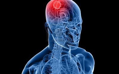 Lập trình nhận biết tế bào ung thư trong não