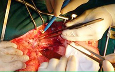 Việt Nam: Ghép thành công đa tạng trên một người