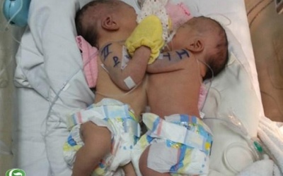 Sức khỏe 2 bé song sinh được tách rời tiến triển tốt