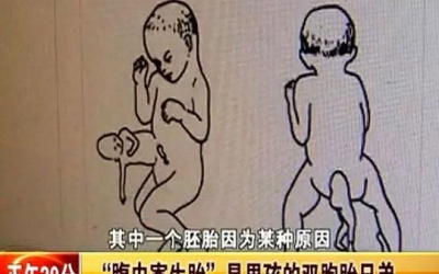 Trung Quốc: Bé trai 2 tuổi 'mang thai'