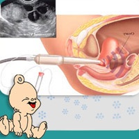 Sai lầm tai hại về thụ tinh ống nghiệm