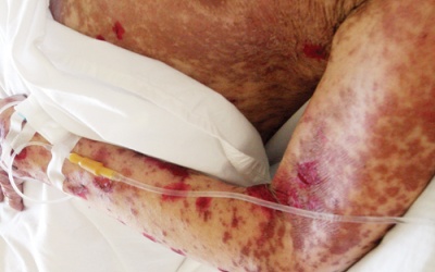 Ngộ độc paracetamol