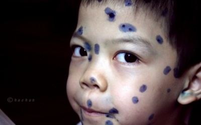 Nhiều điểm tiêm chủng chưa có vaccine thủy đậu