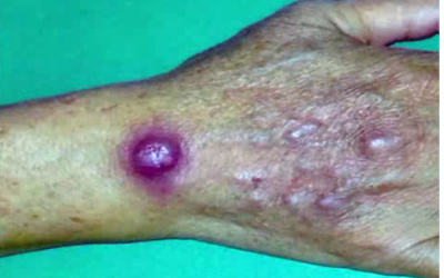 Mỹ: Xuất hiện nhiễm trùng da hiếm gặp ở chợ cá người Hoa