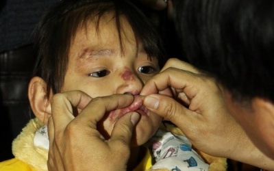 Khám bệnh miễn phí cho 200 bệnh nhân nghèo bị dị tật