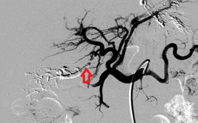 Phát hiện ca rò mạch máu thế giới hiếm gặp