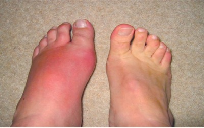 Bệnh gout và cách chữa trị