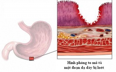 Viêm loét dạ dày mạn tính, làm sao chữa khỏi
