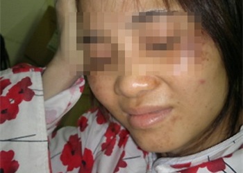 Nhiễm độc khi dùng kem tẩy da chết