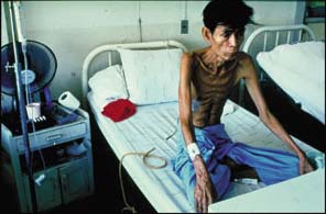 Báo động tỷ lệ mắc mới lao