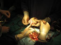 Ghép tạng: 1 người cho trăm người chờ