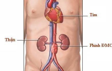 Chứng phình động mạch chủ bụng ở người cao tuổi