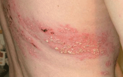 Phân biệt bệnh viêm da do tiếp xúc với côn trùng và bệnh Zona