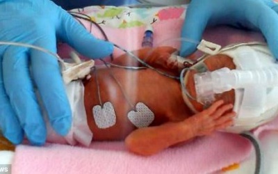 Scotland: Em bé sinh non chỉ nặng 1,3kg sống sót kỳ diệu