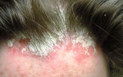 Vẩy nến da đầu: Cần kiên trì điều trị!
