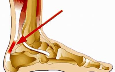 Chứng viêm gân và cách phòng chữa