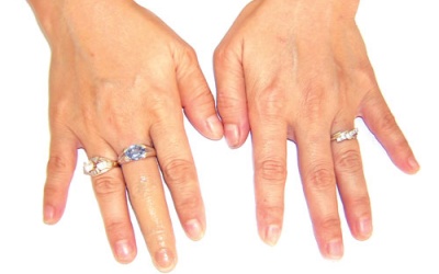 Tự tin hơn sau khi tái tạo ngón tay, chân bị khiếm khuyết