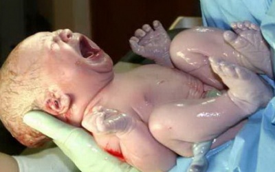 Mổ cứu kịp thời thai nhi có dây rốn bị thắt nút hiếm gặp