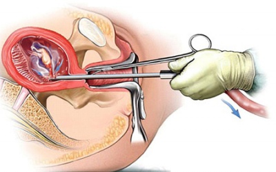 Kỷ lục buồn: Việt Nam thuộc top đầu thế giới về... phá thai