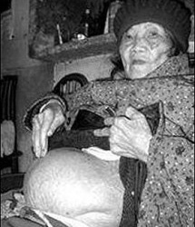 300 phụ nữ mang thai đá trong lịch sử y văn thế giới