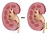 Tán sỏi thận có đau 'kinh hoàng' như bạn tưởng?
