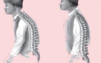 Người bị loãng xương có nên dùng hạ áp chặn calci?