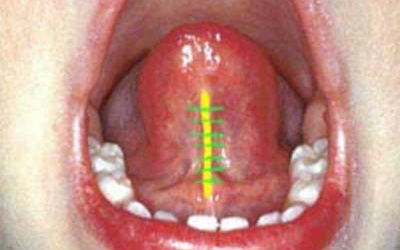 Dính thắng lưỡi là bệnh gì?