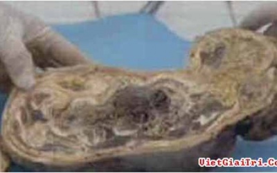 Thông tin mới về vụ cụ bà mang thai đá