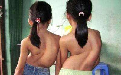 Chỉnh cong vẹo cột sống trễ, tuổi thọ ảnh hưởng nghiêm trọng