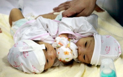 BV Nhi Trung ương: Song sinh dính nhau không quá phức tạp