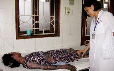 Dị ứng thuốc rộ theo mùa