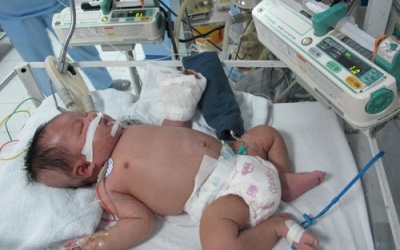 Bé sơ sinh hoại tử cả bàn tay đã tử vong