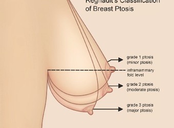 Để ngực không bị chảy xệ