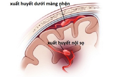 Bệnh xuất huyết mạch não dạng bột