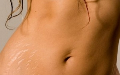 Laser xóa rạn da: Chỉ nên tin... một nửa