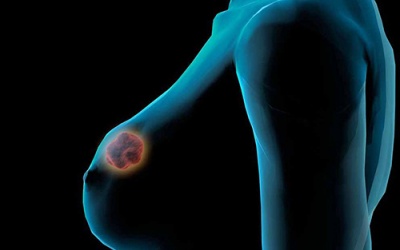 Bệnh lao vú và những điều cần biết