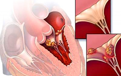 Khi nào nên tiêm phòng thấp tim?