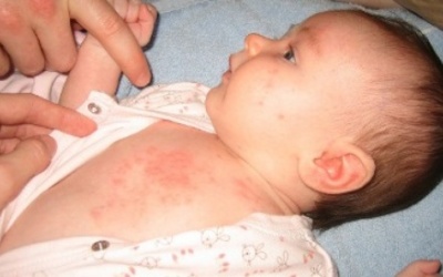 Cách trị rôm sảy cho trẻ